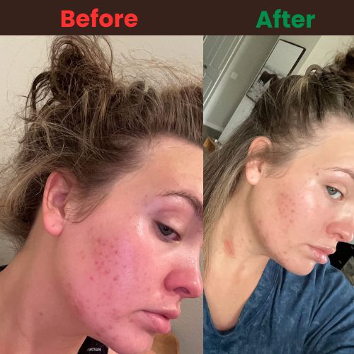 Zinc for Acne 2 Zinc for Acne - Image 2