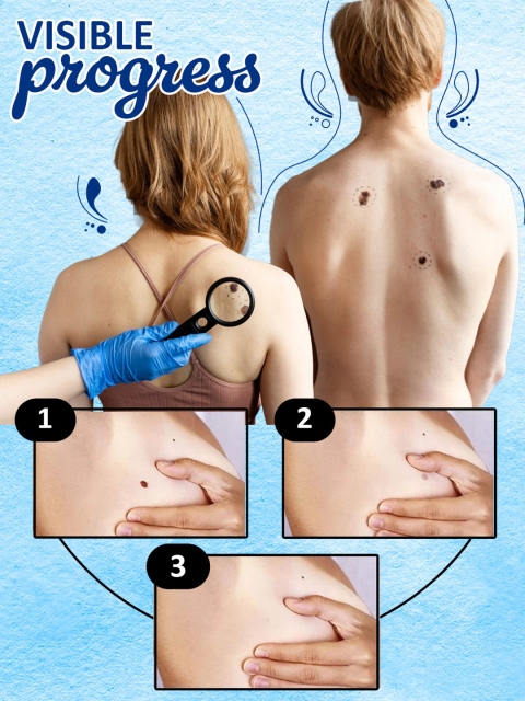 7 DAYS Wart & Tags Painlessly Remover Cream - 50g 6 7 DAYS Wart & Tags Painlessly Remover Cream - 50g