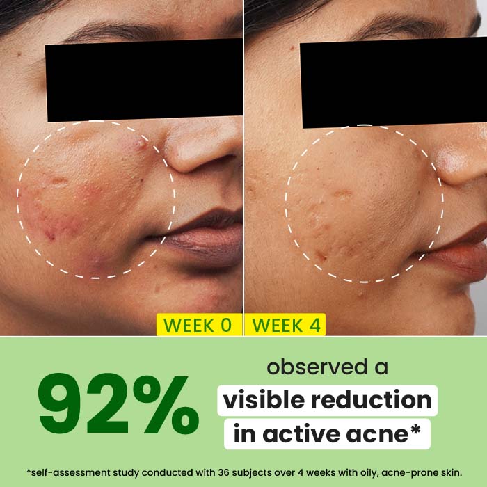 Cica + 2% Salicylic Acid Serum for Acne & Oil Control 3 Cica + 2% Salicylic Acid Serum for Acne & Oil Control