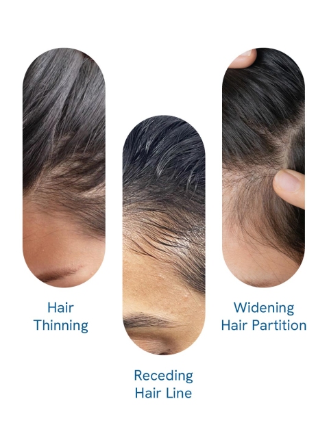 Be Bodywise Hair Growth Serum Roll On with Rosemary & Redensyl for Hair Growth - 25 ml 5 Be Bodywise Hair Growth Serum Roll On with Rosemary & Redensyl for Hair Growth - 25 ml